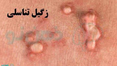 زگیل تناسلی