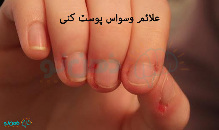 علائم-وسواس-پوست-کنی