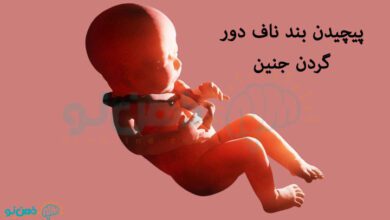 پیچیدن بند ناف دور گردن جنین