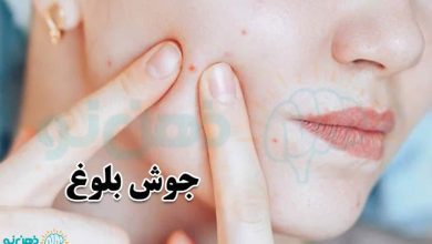 جوش بلوغ