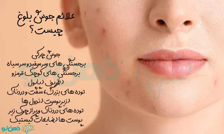 علائم جوش بلوغ