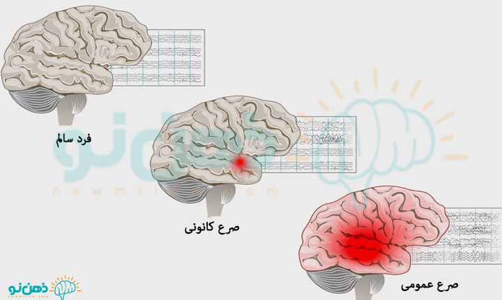 انواع حمله صرع