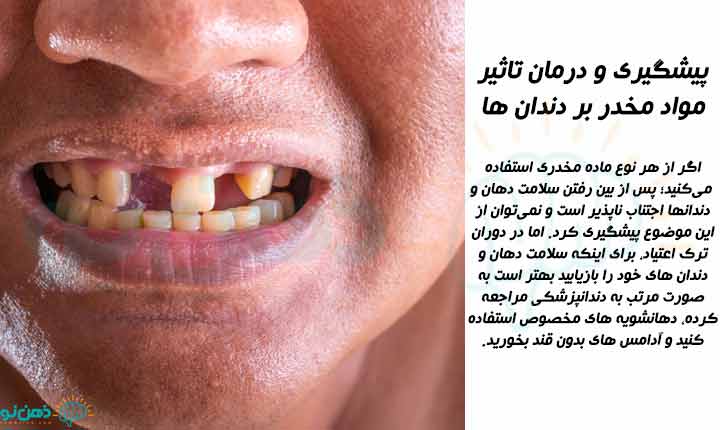 درمان تاثیر مواد مخدر بر دندان ها