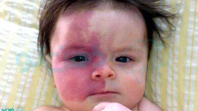 ماه گرفتگی نوزاد