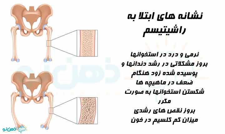 نشانه های ابتلا به راشیتیسم