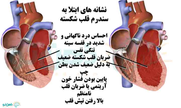نشانه های سندرم قلب شکسته