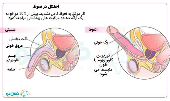 ویاگرا چقدر تأخیر دارد + نعوظ چیست + ارگاسم در خواب + بهترین قرص تاخیری