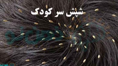 شپش سر کودک