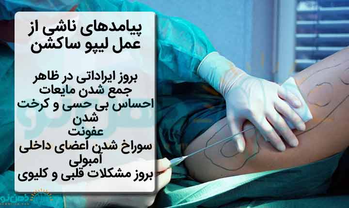 پیامدهای عمل لیپو ساکشن