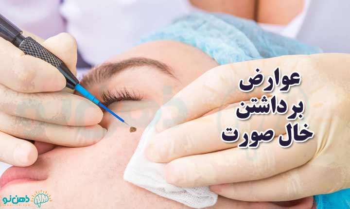 عوارض برداشتن خال صورت
