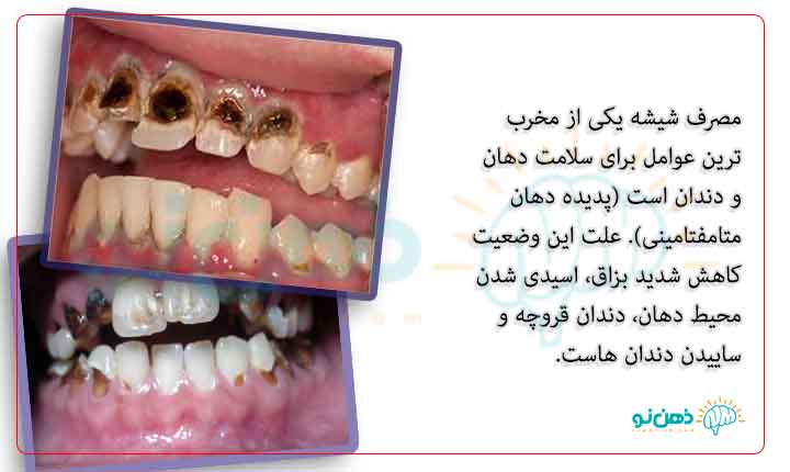 پوسیدگی دندان ناشی از اعتیاد به شیشه