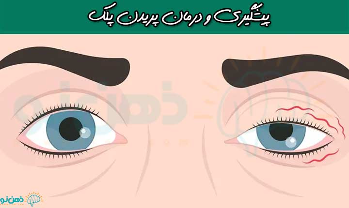 پیشگیری و درمان پریدن پلک