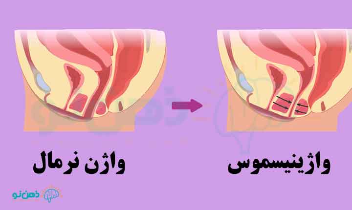 حالت واژینیسموس