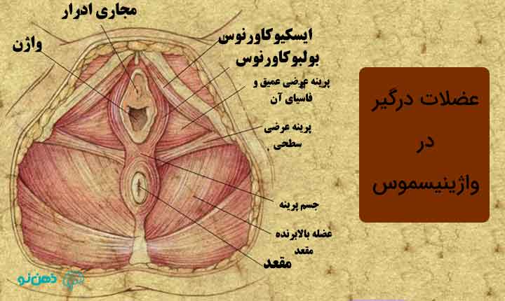 گرفتگی عضلات وازینیسموس